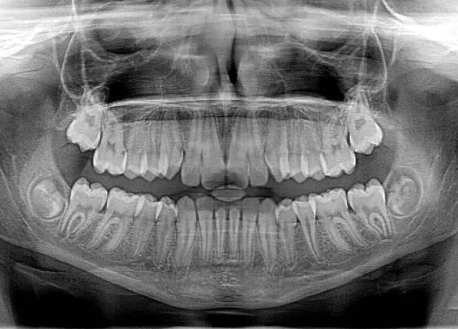 X-rays